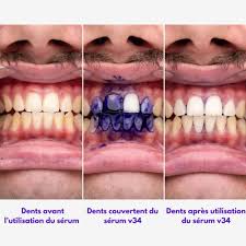 Smilekit Blanchisseur de Dent - V34